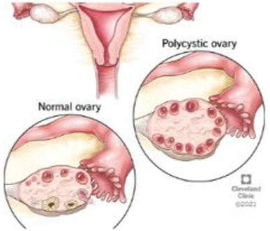 Home pcod/pcos treatment