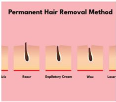 Home permanent hair removal